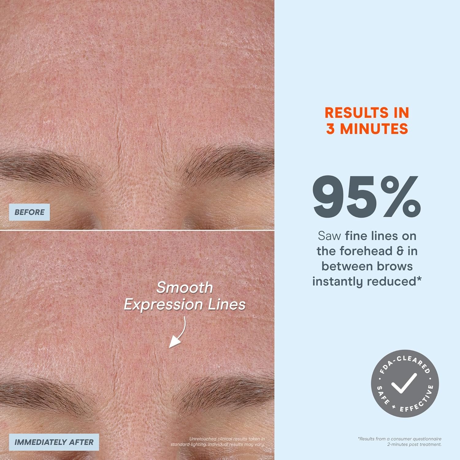 NuFACE FIX MicroWand Microcurrent Facial Device, FDA Cleared - Eyes, Lips & Lines Treatment with Serum Activator - Lip Plumper, Eye Depuffing Wand, Wrinkle & Smile Line Reducer, 3 On-The-Go Modes - Image 7