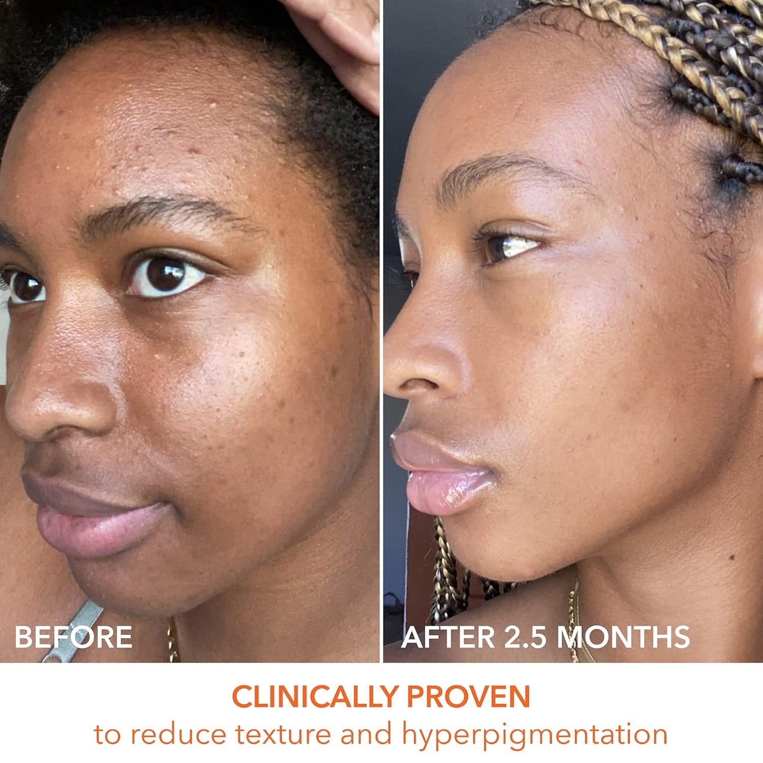 Dr. Dennis Gross Alpha Beta Universal Daily Peel: for Uneven Tone or Texture and Fine Lines or Enlarged Pores, (60 Treatments) - Image 7