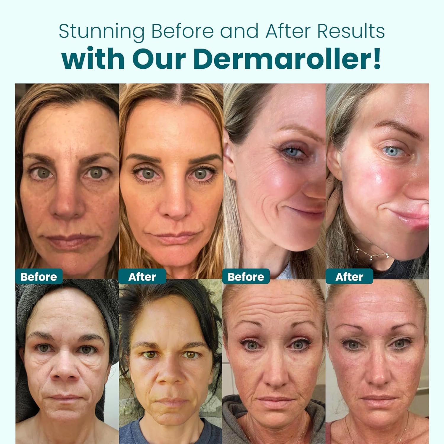 Derma Roller 0.25 mm with Individual Needles | Facial, Scalp & Head Micro-Needling Tool for Enhanced Skincare Routine - Gin Amber Beauty - Image 6